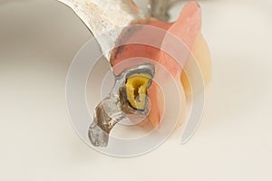 Bugel remove dentures with attachments