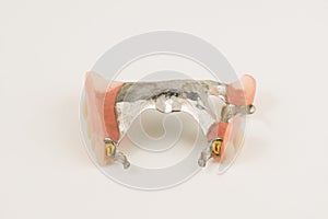 Bugel remove dentures with attachments