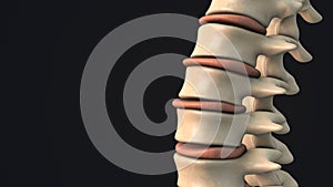 Bulging disc in the human spine