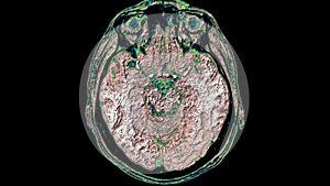 Bulk multicoloured MRI scans of the brain and head to detect tumours. Diagnostic medical tool