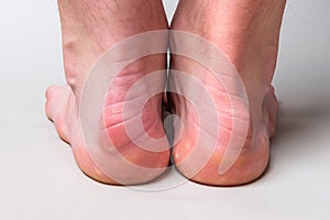 Bump on the back of heel bone called Haglund`s deformity on gray background.