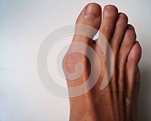 A bump on the big toe of the man physiological health problem