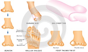 Bunion