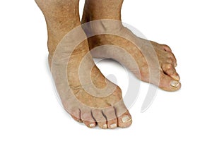 Bunion deformity