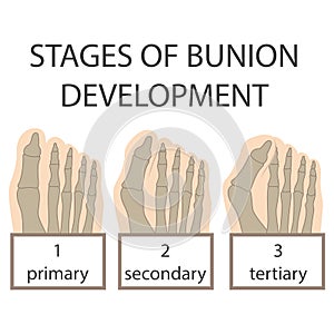 Bunion development