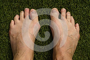 Bunion on left foot of an adult white woman on astro turf. Toe nails are not painted.