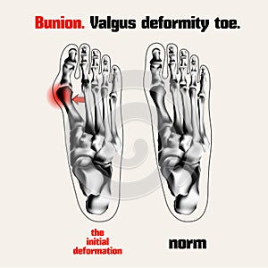 Bunion. Valgus deformity toe.