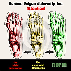 Bunion. Valgus deformity toe.
