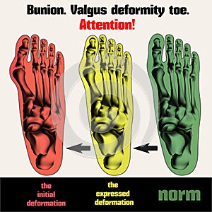Bunion. Valgus deformity toe.