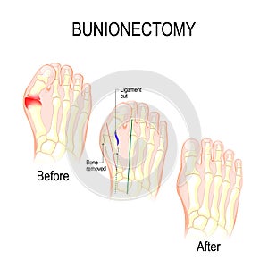 Bunionectomy. surgery to correct pathologies of the foot. photo