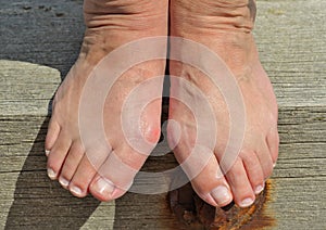 Bunions