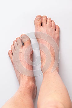 Bunions. Hallux valgus, feet 