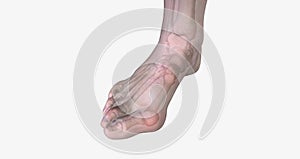 The Bunions and Overlapping Toes