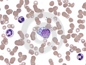 Burkitt lymphoma in peripheral blood.