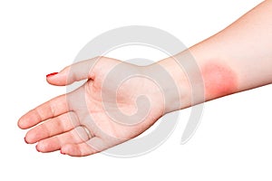 Burn on female hand with red nails isolated on white background