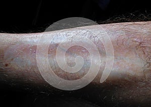 Burn scar on male leg