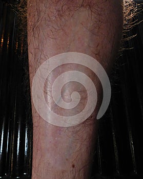 Burn scar on male leg