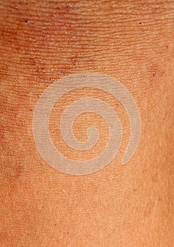 A burn scar that is partly healed