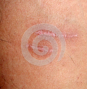 A burn scar that is partly healed