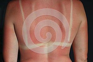 Burn from the sun on the body