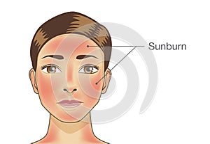 Burned skin on facial of woman and neck.