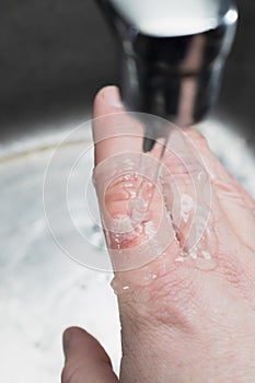 Burned skin on a finger. Caucasian man keeps hand under the cold running water