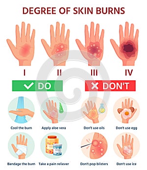 Burns degree. First aid for burn wound. Fire damage to skin classification. Hand blisters. Vector infographic treatment