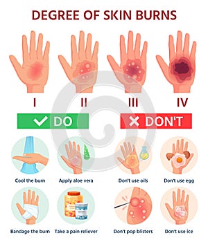 Burns degree. First aid for burn wound. Fire damage to skin classification. Hand blisters. Vector infographic treatment photo