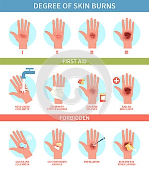 Burns degree. Thermal wound first aid, skin scalds and blisters emergency help. Treatment instruction thermic injury