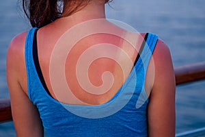 Burnt female skin in the sun close-up in a blue t-shirt