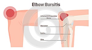 Bursitis. Elbow joint inflammation. Inflamed or irritated bursae of synovial