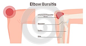 Bursitis. Elbow joint inflammation. Inflamed or irritated bursae of synovial photo