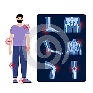 Bursitis icons set