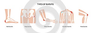 Bursitis icons set