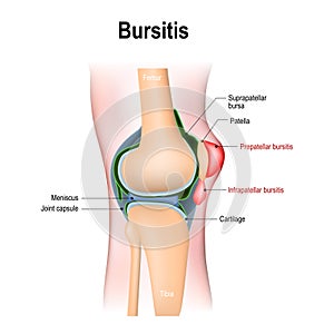 Bursitis is the inflammation of bursae photo