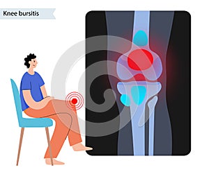 Bursitis inflammation concept