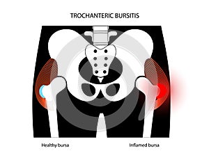 Bursitis inflammation concept