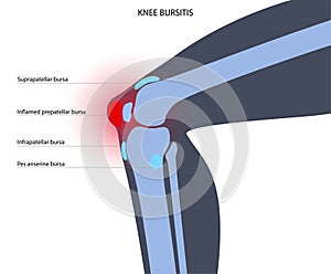 Bursitis inflammation concept