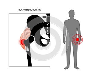 Bursitis inflammation concept