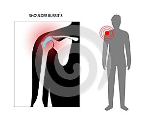 Bursitis inflammation concept