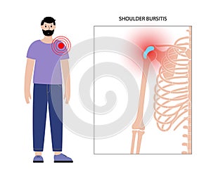 Bursitis inflammation concept