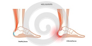 Bursitis inflammation concept