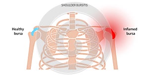 Bursitis inflammation concept photo