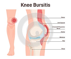 Bursitis. Knee joint inflammation. Inflamed or irritated bursae of synovial