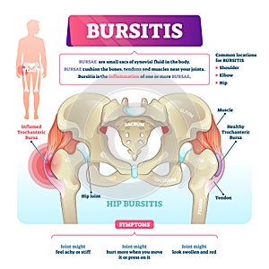 Bursitis vector illustration. Labeled bursae synovial inflammation scheme.