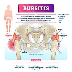 Bursitis vector illustration. Labeled bursae synovial inflammation scheme. photo