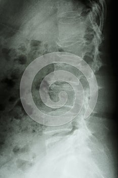 Burst fracture at lumbar spine