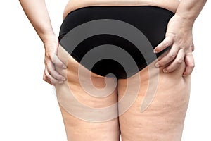 Buttock and leg cellulite problem young fat woman stretch marks