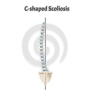 C-shaped scoliosis. Dextroscoliosis. Levoscoliosis. Spinal curvature, kyphosis, lordosis, scoliosis, arthrosis