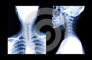 C-spine or x-ray image of Cervical spine AP and Lateral view